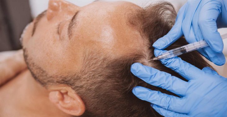 PRP treatment